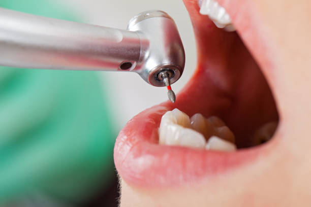 Best Emergency Tooth Extraction in Moose Wilson Road, WY